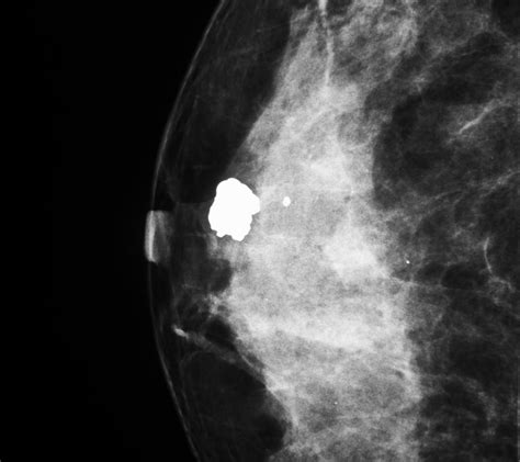 Mammogram Images Normal Abnormal And Breast Cancer
