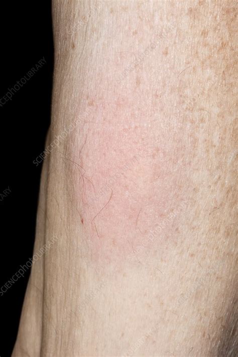 Allergic Reaction To Tick Bites