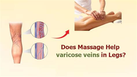 Does Massage Help Varicose Veins In Legs