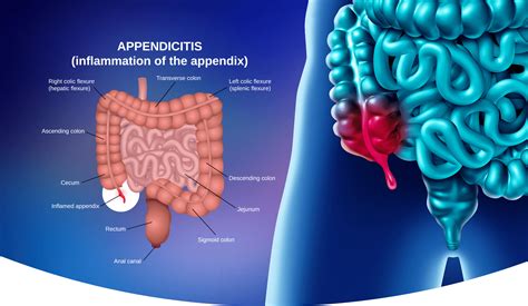 Best Appendicitis Treatment In Delhi Appendicitis Surgery In Delhi