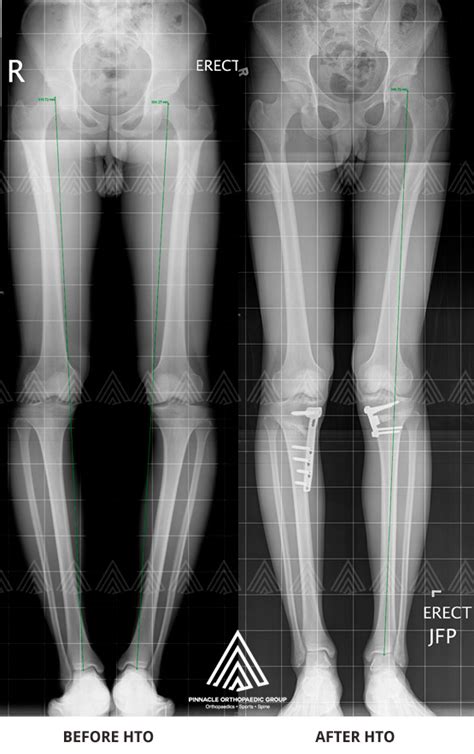 Osteotomy Singapore Knee Pain Recovery Specialist Surgeon