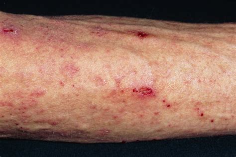 Itch has wrinkled her skin severely. Rash - Brownlow Health Central