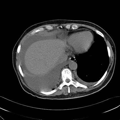 Множественная миелома диета Мрт что это такое миелома Мрт что это такое миелома Множественная миелома диета
