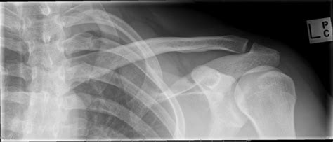 Fractured Collarbone Recovery What Happens When A Collarbone Breaks