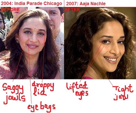 Madhuri Dixit Plastic Surgery Bollywood Actresses Before And After
