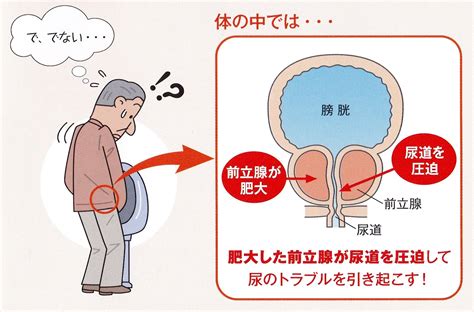 前立腺肥大症の治療で使われるお薬とその効果 北海道旭川市の神楽岡泌尿器科のブログ