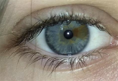This Is My Eye I Have Sectoral Heterochromia Reyes