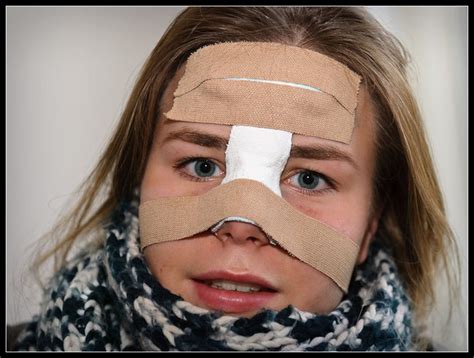 Maybe you would like to learn more about one of these? First Aid for Broken Nose