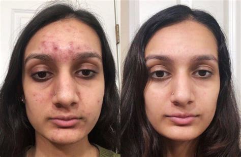 My Accutane Journey 6 Month Results Before After Side Effects Would I