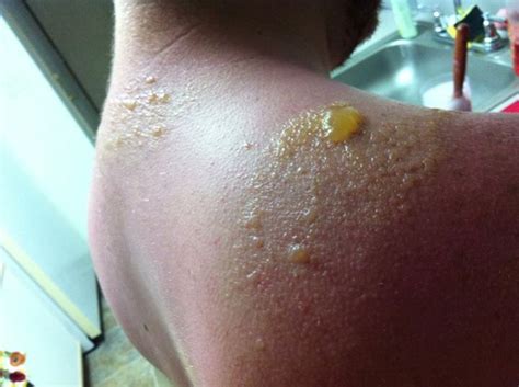 Pin By Maxine Cooper On Injuries 2nd Degree Burns Severe Sunburn