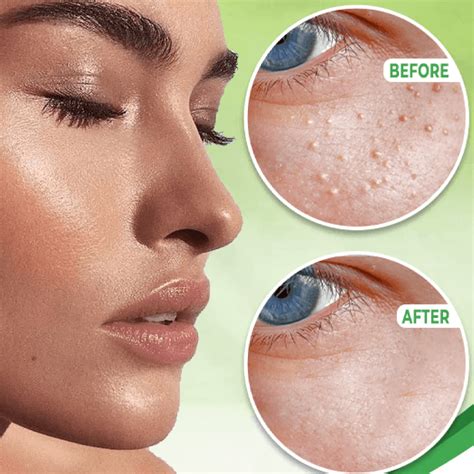 Eye Milia And Spot Remover Cream Inspire Uplift