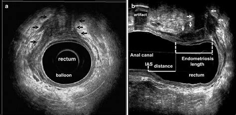 Endoanal Ultrasonographic Imaging Of The Anorectal Cysts And Masses Abdominal Key