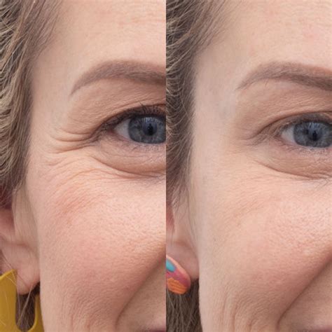 Anti Wrinkle Injections And Wrinkle Relaxers Perth Blanc Skin