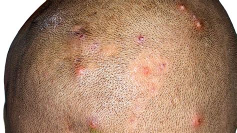Sores And Scabs On Scalp Causes Treatment And Prevention Vlrengbr