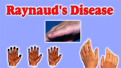 Raynaud Disease जानिए इस अजीब से रोग का क्या है आयुर्वेद में इलाज। Youtube