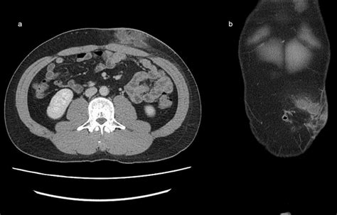 Abdominal Computed Tomography Ct With Contrast Medium Revealed