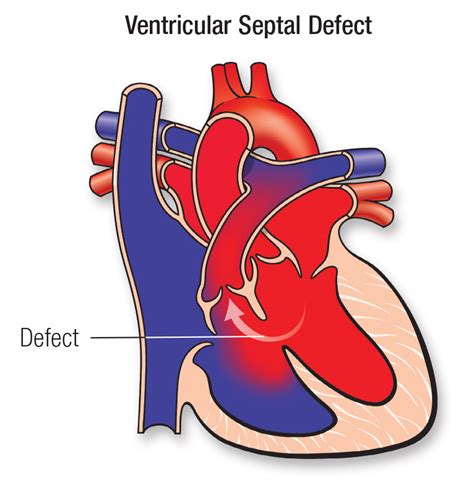 Ventricular Septal Defect Vsd Seattle Childrens