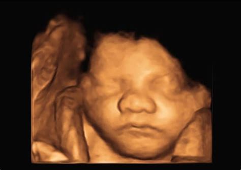 What Is The Difference Between 2d 3d 4d Ultrasounds