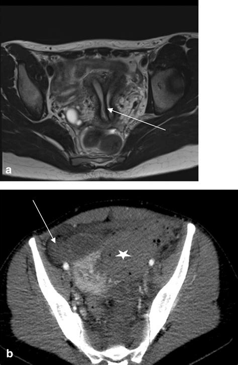 Uterine Perforation In A 26 Year Old Woman With Persistent Abdominal