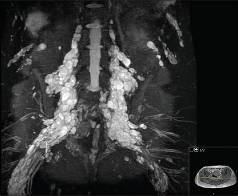 Utility Of Mri Neurography In Neurofibromatosis Type I Case Example