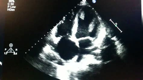 Echocardiogram Thrombus In The Left Ventricle Youtube