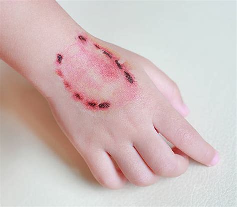 Top 90 Pictures What Does An Infected Wound Look Like Pictures