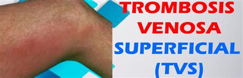 Learn about the symptoms and treatment of this condition. Trombosis Venosa Superficial | GLOMACH MEDIC VARICES