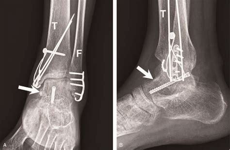 Surgery Site 3 Mo After Surgery Hawkins Sign Is Noted On Download