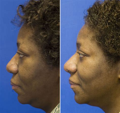 Ethnic Rhinoplasty Seattle Facial Plastic Surgeon Dr Lamperti