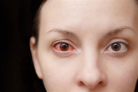 Wylew w oku objawy przyczyny i leczenie Co robić gdy pojawi się pęknięte naczynko w oku