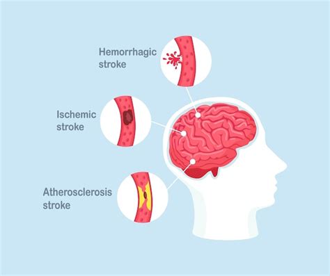 Premium Vector Types Of Human Brain Stroke Ischemic Atherosclerosis