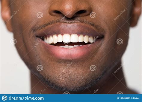 Close Up View Of Beaming Orthodontic White Wide Male Smile Stock Image