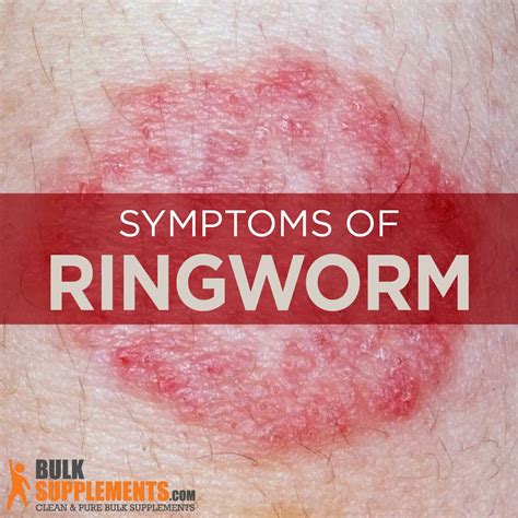 Ringworm Home Treatment Discover The Secret To Remove Ringworm