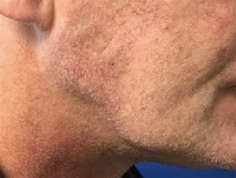 Sebaceous Cyst Face Removal