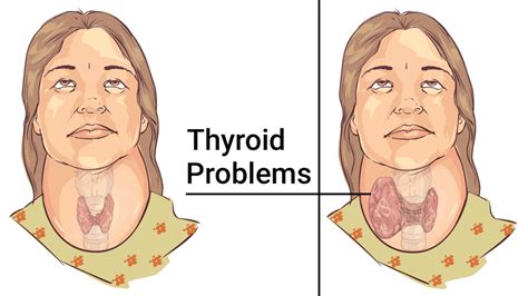 5 Easy Ways To Relieve Thyroid Problems Naturally