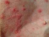 Images of Bed Bug Spray Cancer