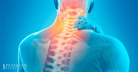 Neck Pain What Causes It Severity Levels And How Its Treated