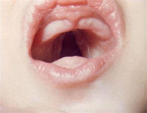 Cleft Palate Syndrome