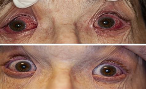 Dupilumab Associated Ocular Surface Disease Clinical Charac Cornea