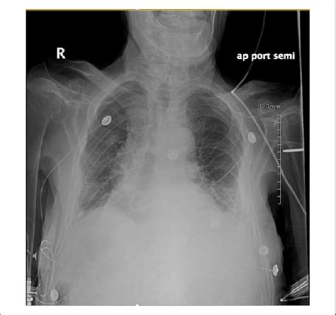 Chest X Ray Showing Bilateral Bibasilar Infiltrates With Subtle