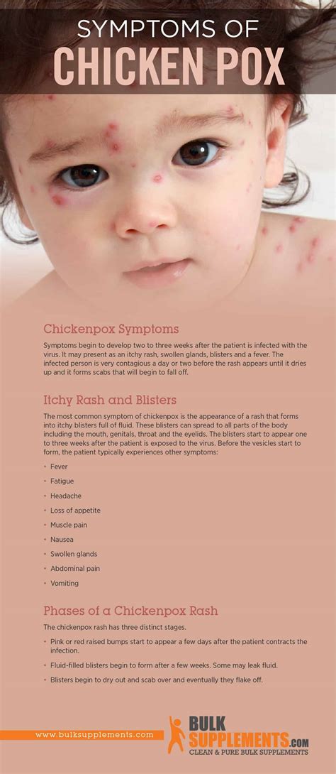 ﻿varicella Chickenpox Causes Symptoms And Treatment