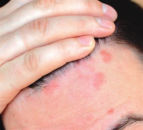 Red Spots On Scalp Pictures Causes And Treatments