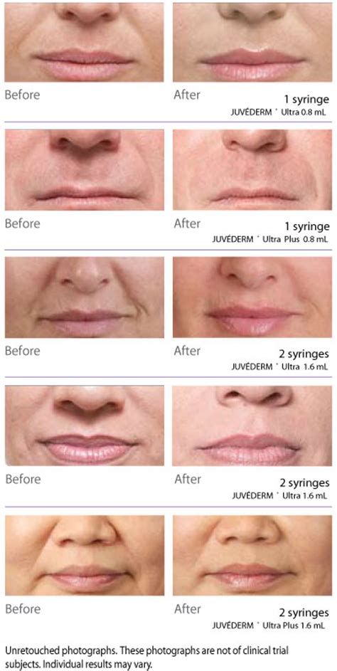 Dermal Fillers Juvederm Ultra Plus Xv And Voluma Xc Pearland Med Spa