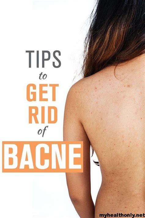 14 Best Home Remedies For Back Acne You Must Know My Health Only