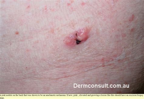 Many factors can increase your risk for uv radiation from the sun is the number one cause of skin cancer. Dermatology For Pharmacists: Skin Cancer/Tumours - Common ...