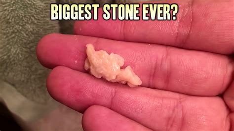 Extreme Tonsil Stone Removal Pt 2 Youtube