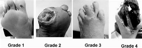 The wagner and the university of texas wound classification systems. Wagner Classification for diabetic foot. Grade 1 ...