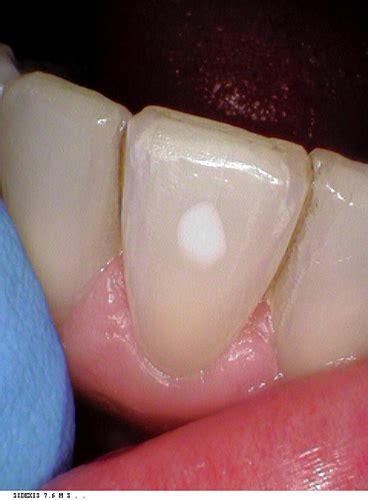Removing White Spots On Teeth St Lawrence Dentistry