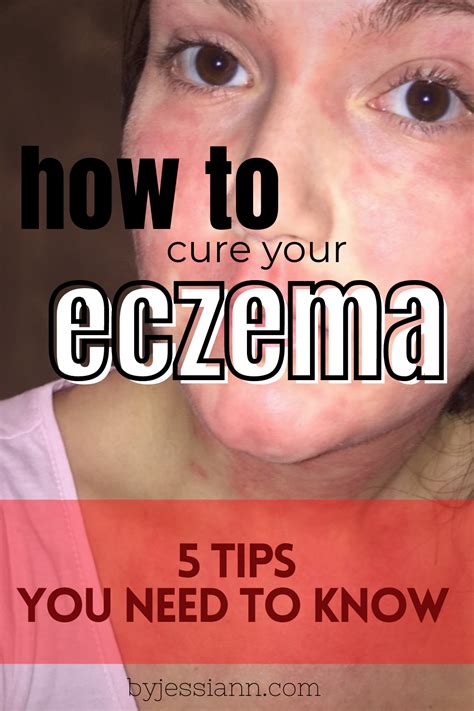 How I Finally Cured My Eczema Learn How To Heal Your Eczema For Good