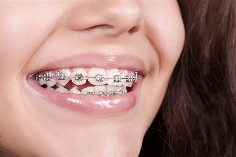 Dental Braces Treatment In Delhi Ncr Orthodontic Treatment Wires And